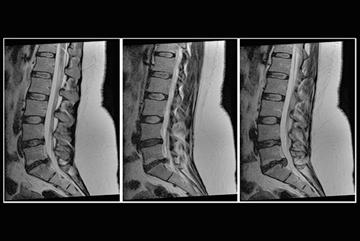 Cauda equina syndrome: Changes to NICE CKS red flags
