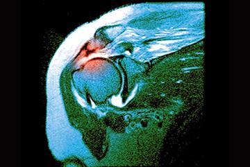Management of a rotator cuff tear