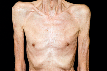 Unintended weight loss - red flag symptoms