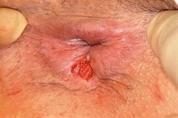 Red flag symptoms: Rectal bleeding