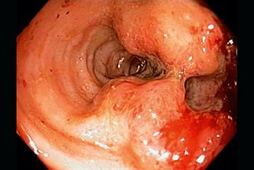 Clinical Review: Colorectal cancer