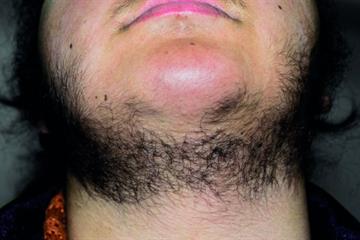 Red flag symptoms: Hirsutism