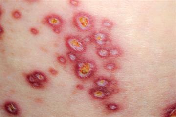 Pictorial case study - Red mucinous papules