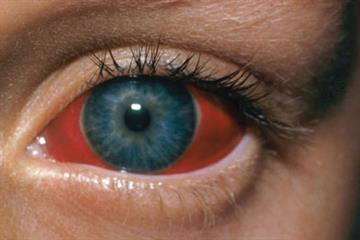 Pictorial case study - Red eye with unaffected vision