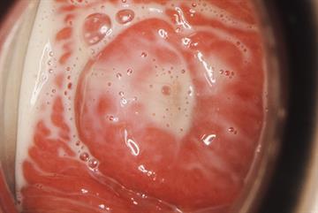 Abnormal vaginal discharge - red flag symptoms