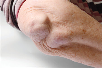 Timely diagnosis of rheumatoid arthritis