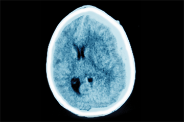 Persistent headache - Red flag symptoms