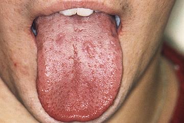 GPs urged to be vigilant for syphilis after cases soared 22% in 2015