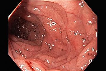 Coeliac disease: hot topic