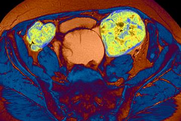 Early diagnosis: Ovarian cancer