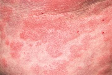 Improve your knowledge of skin conditions with new articles from MIMS Dermatology