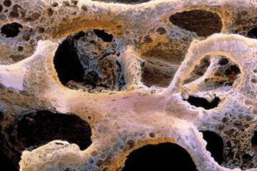 Questions on osteoporosis