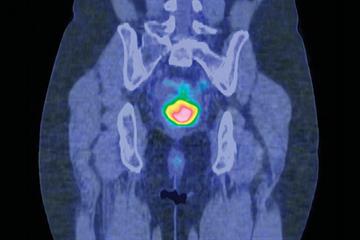 Clinical Review: Cervical cancer