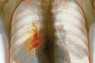 Non-small cell lung cancer - Clinical review