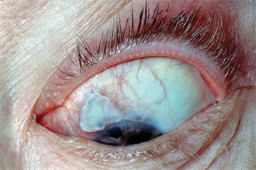 Differential diagnoses: Eye problems