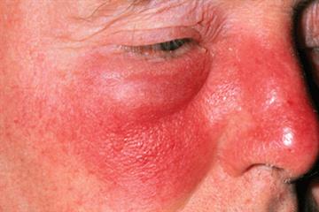 Clinical Review - Cellulitis and erysipelas