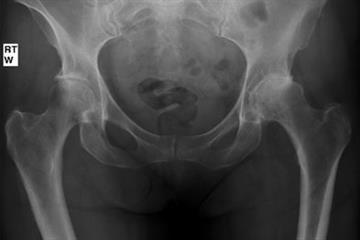 Clinical Review - Hip and knee replacements