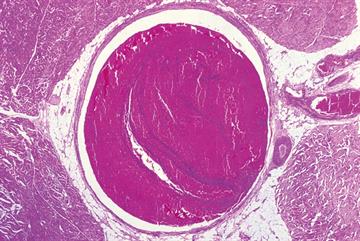 Upper extremity DVT - case study