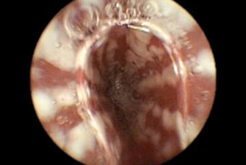 Red flag symptoms: Dysphagia