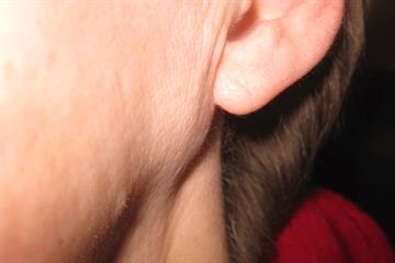 The basics - Assessing parotid swellings