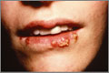 The basics - Herpes infections