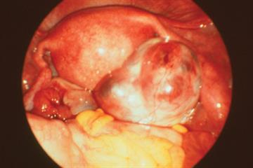 Polycystic ovary syndrome