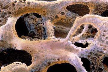 Evidence base: Osteoporosis