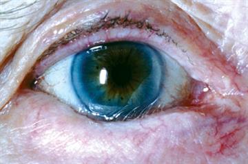 Clinical images: Conditions affecting the eye