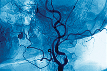 Journals watch: TIA, carpal tunnel syndrome and anaemia