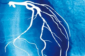 The Basics - Stable angina
