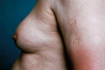 The Basics - Gynaecomastia