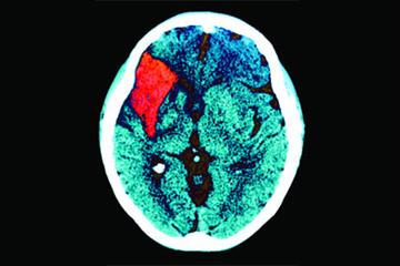 Secondary prevention of stroke