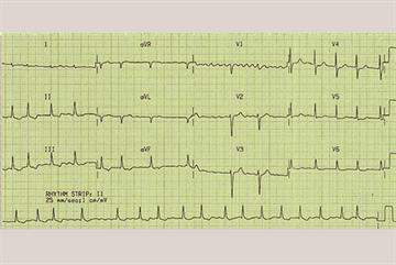 Clinical review: Atrial fibrillation