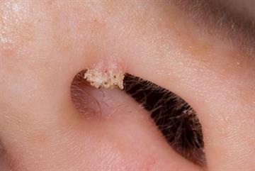 Differential diagnoses: Warts