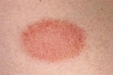 Differential diagnoses - Tinea, BCC, herald patch and fixed drug eruption