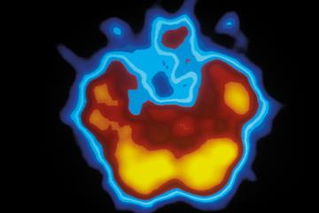 Epilepsy - Clinical review