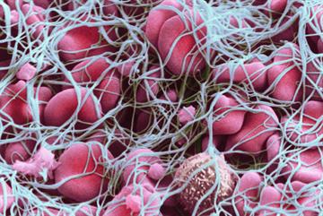 Antiphospholipid syndrome: diagnosis and management
