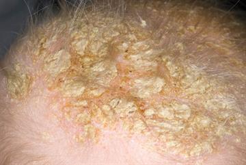 Seborrhoeic dermatitis - Clinical review