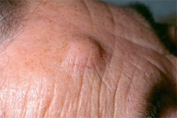 Differential diagnoses - Benign skin lesions