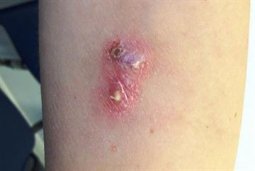 Skin reaction after progestogen implant case study