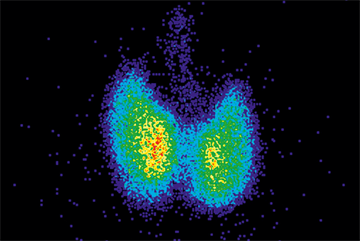 Clinical Review: Hyperthyroidism