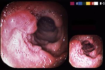 Early diagnosis: Bowel cancer