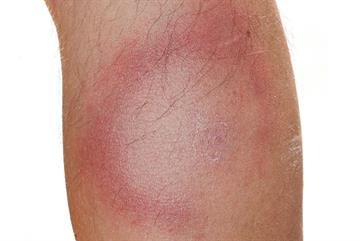 Erythema - red flag symptoms