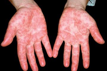 Skin conditions in young children