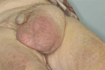 Differential diagnoses: Scrotal lesions