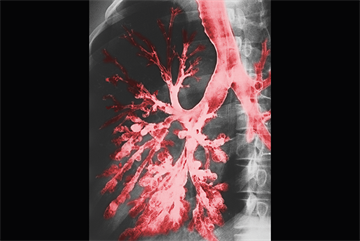 Red flag symptoms: Haemoptysis