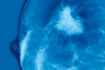 Doubts over breast cancer screening in elderly