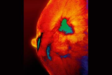 Clinical Review: Breast cancer
