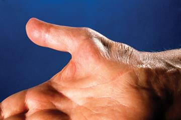 Common conditions of the hand