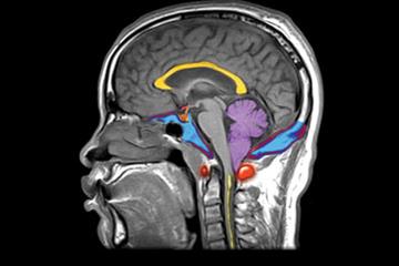 Case study - A history of headaches